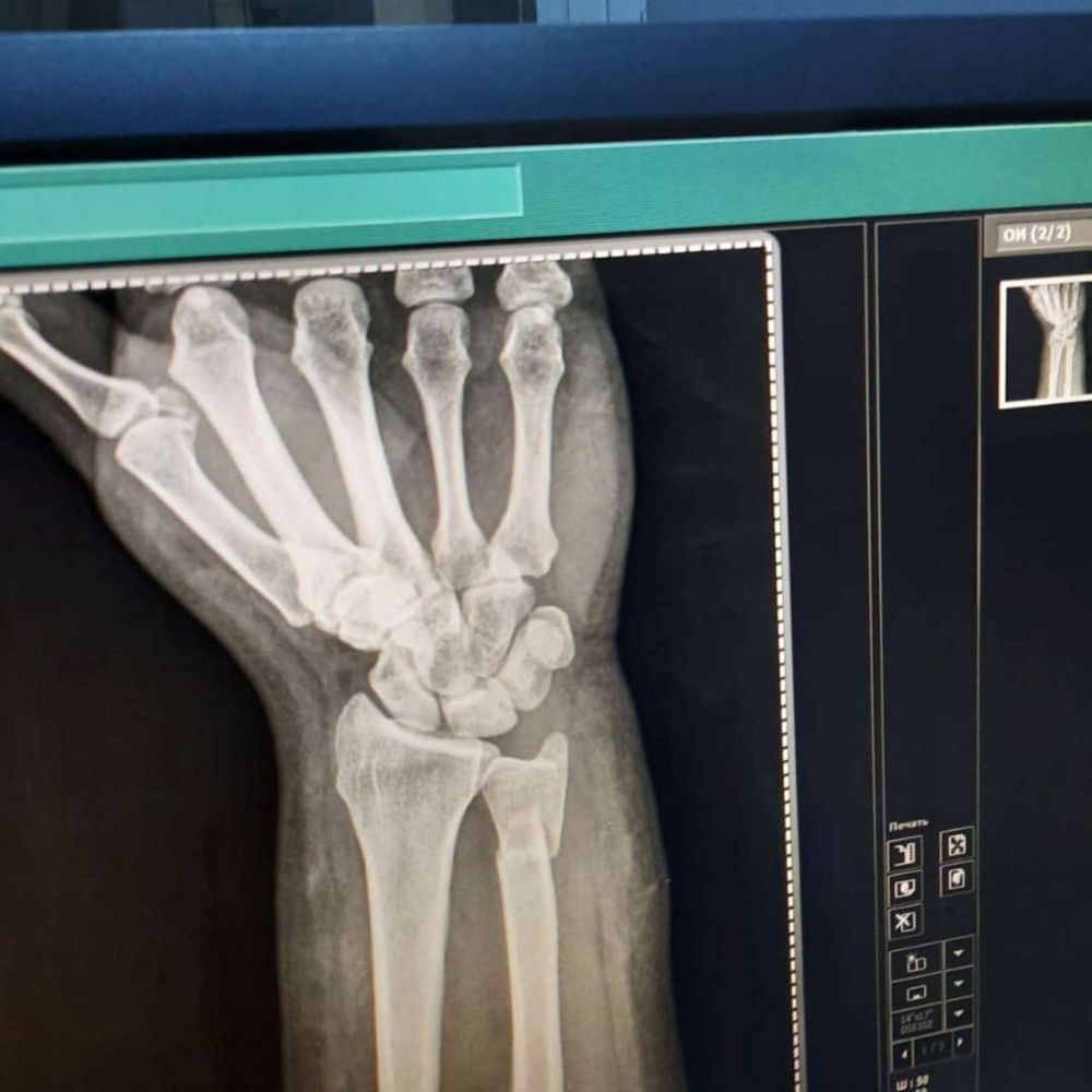 Azərbaycanlı aparıcının biləyi qırıldı -FOTOLAR