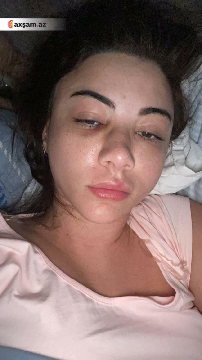 Azərbaycanlı müğənni qəza törətdi, üzü tanınmazhala düşdü - FOTOLAR