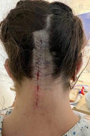 Beyin əməliyyatından çıxan kimi çılpaq şəkillərini paylaşdı- FOTOLAR