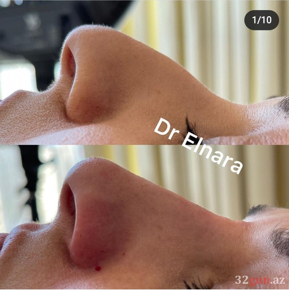 Xəstələrinin dodaqlarını cürüdən kosmetoloq yenidən fəaliyyətə başladı -Onu Qənirə Paşayeva ilə nə bağlayır? (FOTO)