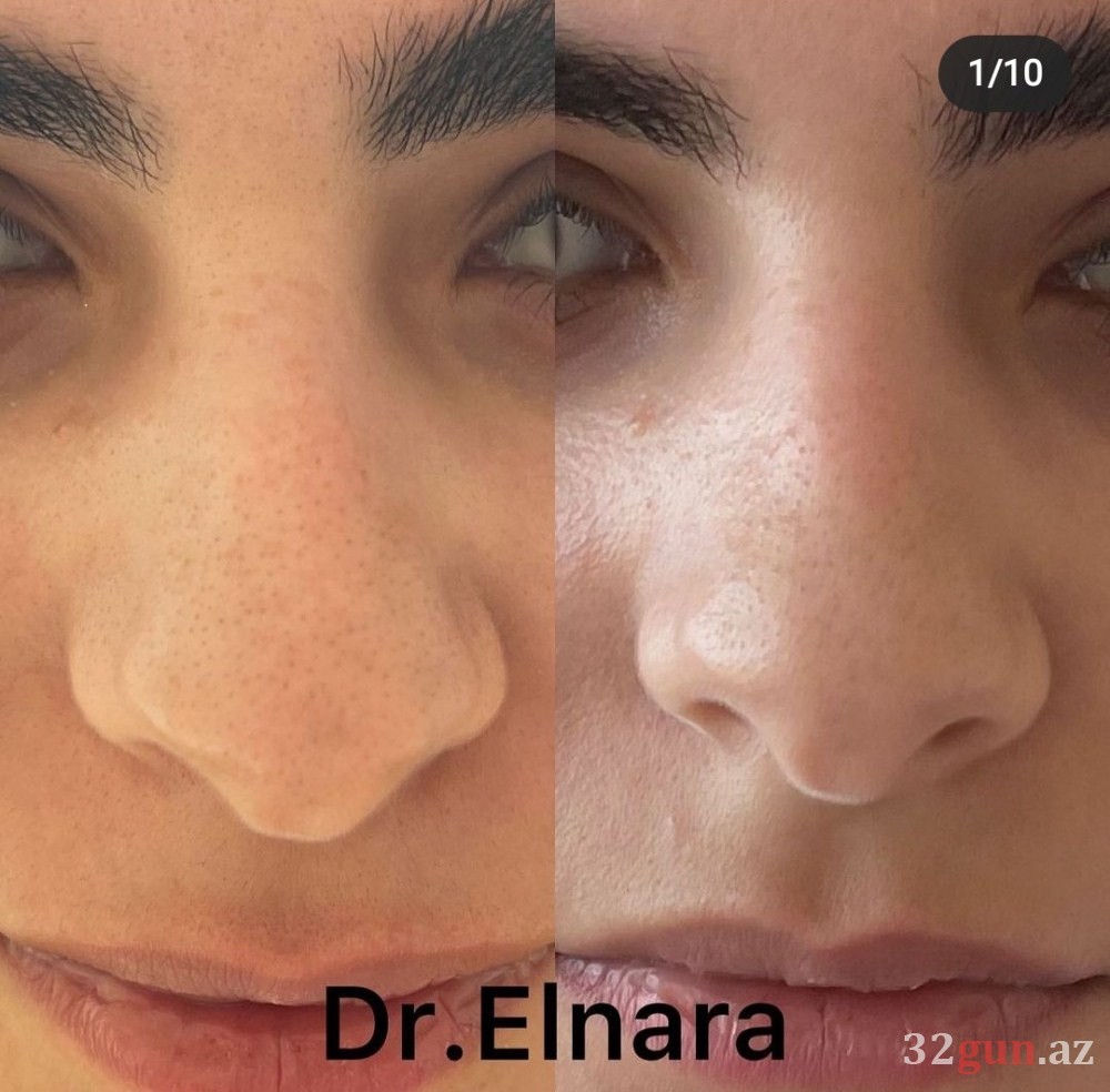 Xəstələrinin dodaqlarını cürüdən kosmetoloq yenidən fəaliyyətə başladı -Onu Qənirə Paşayeva ilə nə bağlayır? (FOTO)