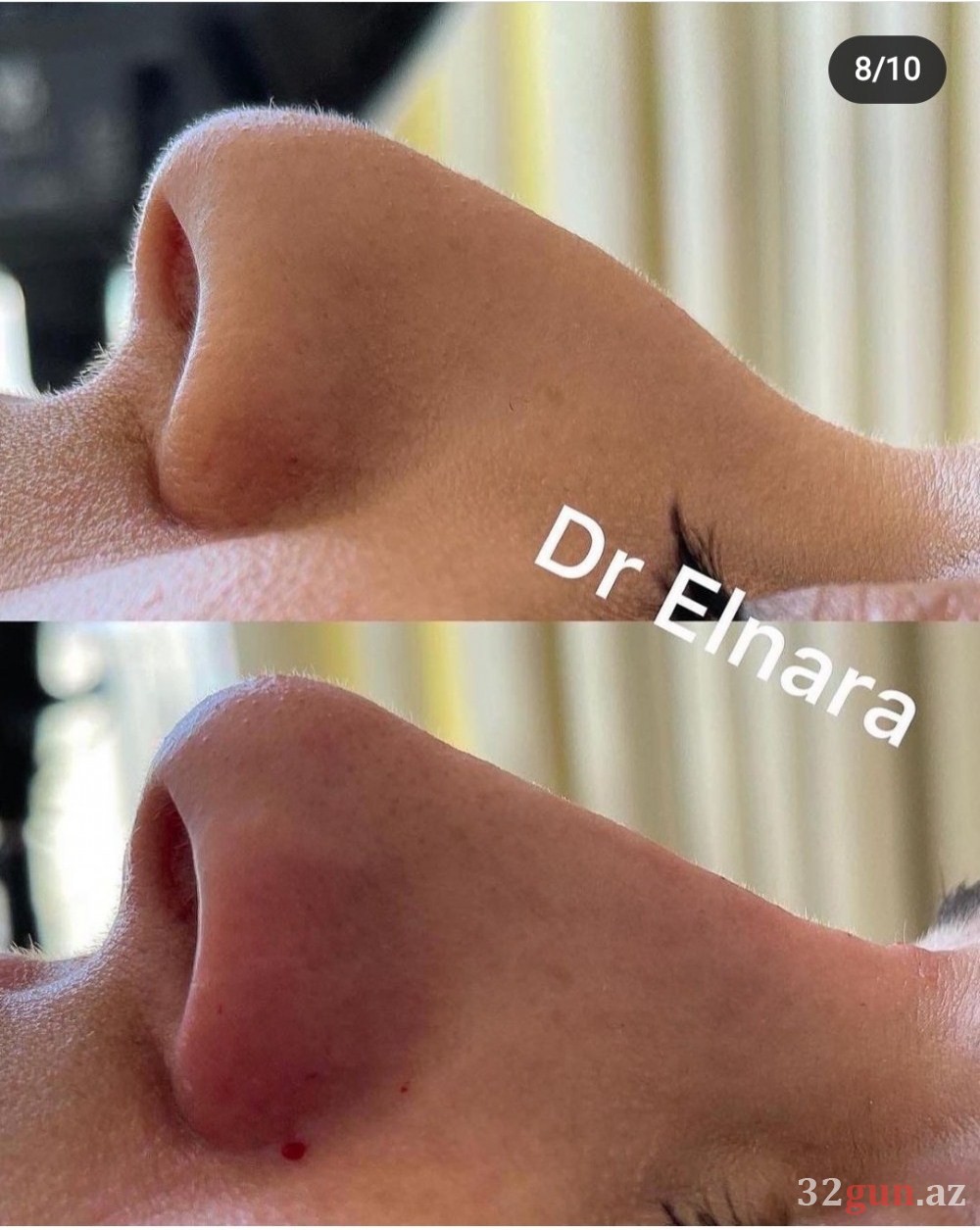 Xəstələrinin dodaqlarını cürüdən kosmetoloq yenidən fəaliyyətə başladı -Onu Qənirə Paşayeva ilə nə bağlayır? (FOTO)