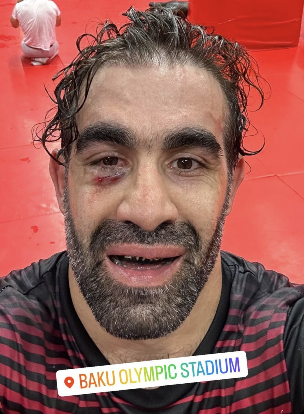 Rafael Ağayevin gözü çapıldı- FOTO