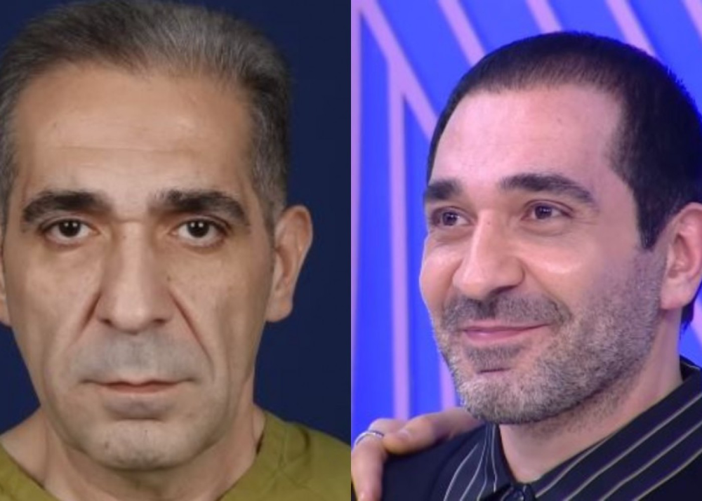 Nurlan Əzizbəyli plastik əməliyyatla üzünü dəyişdirdi