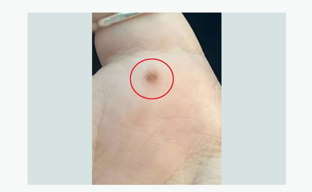 "ChatGPT" qadına fotodan əlini analiz etdikdən sonra təcili olaraq xəstəxanaya getməyi tövsiyə etdi